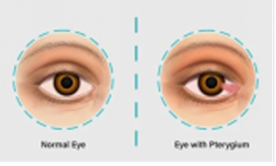 नाखूना (Pterygium)