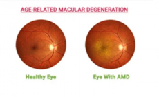 आख की मैक्यूला का व्यपजनन